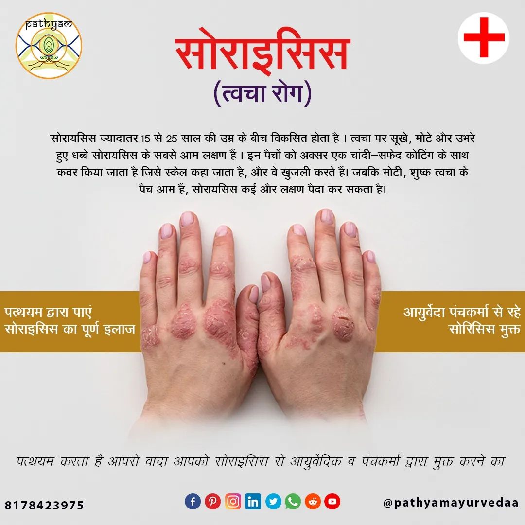 Psoriasis Ayurveda Treatment