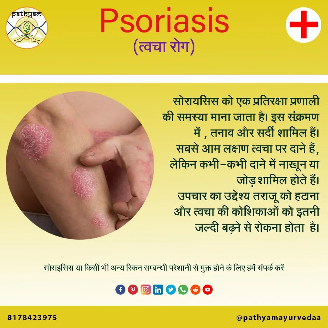 Cure of Psoriasis