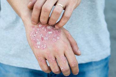 Ayurvedic Treatment for Skin Diseases in Delhi NCR